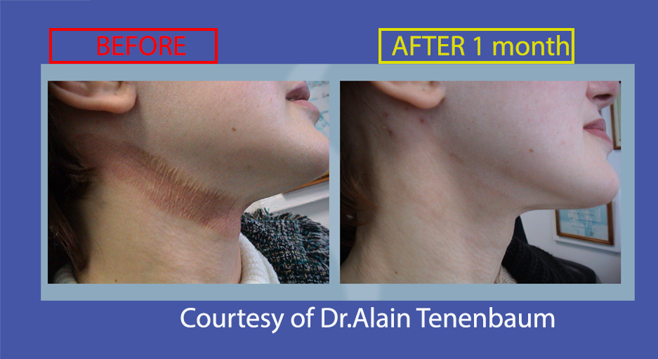 neck chemodermabrasion complication