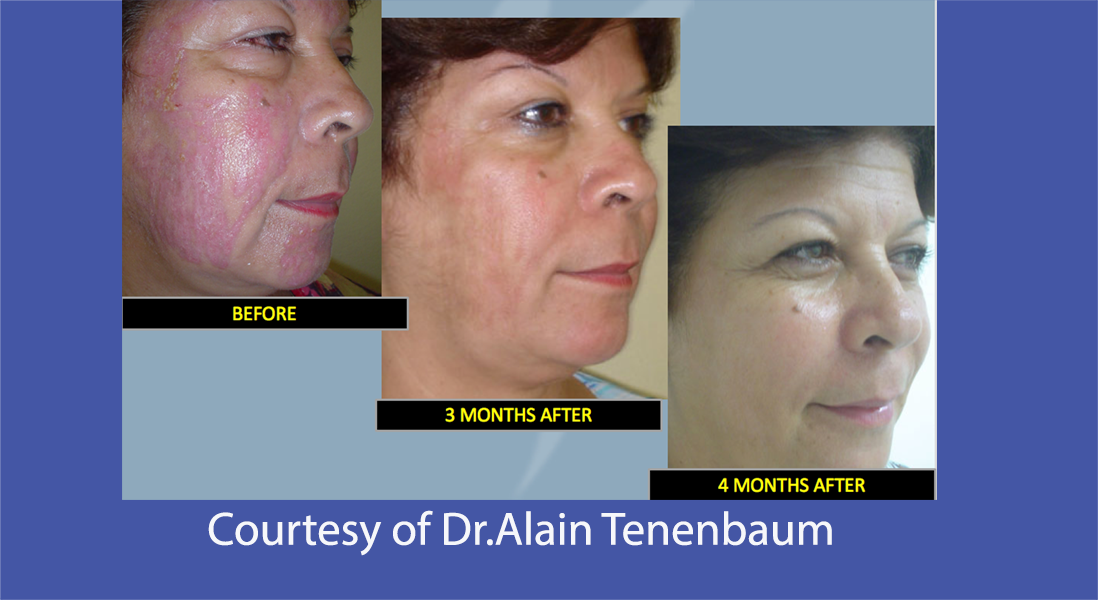 treatment of complication post glycolic acid