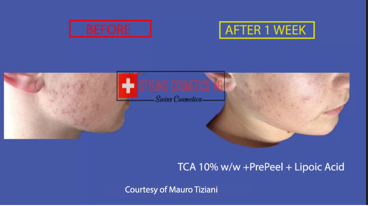 acne-treatment-mauro-tiziani